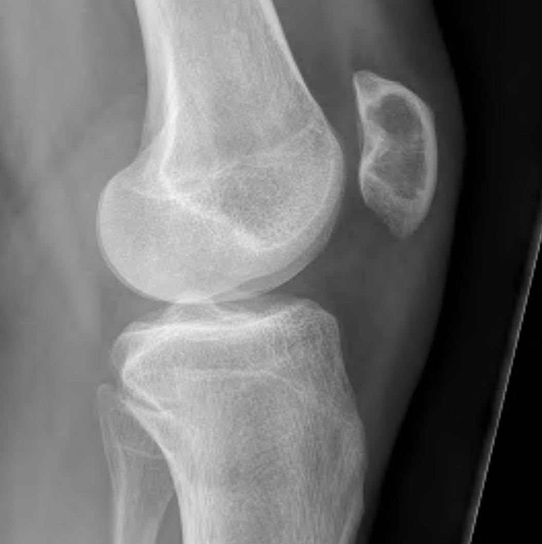 Patella Lytic Lesion